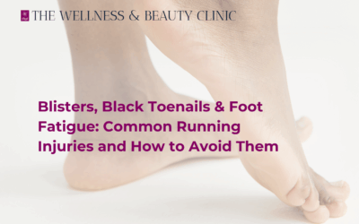 Blisters, Black Toenails & Foot Fatigue: Common Running Injuries and How to Avoid Them