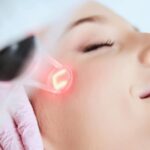laser treatment